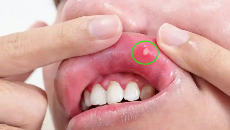 B Vitaminleri Eksikliği: 5 Belirgin Belirtiyi Sakın Görmezden Gelmeyin!